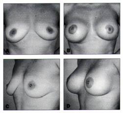 Figure 7. A and C, Preoperative views of a 44 year old female patient with grade I ptosis. B and D, Postoperative views after simultaneous periareolar mastopexy and breast augmentation. Figure 8.