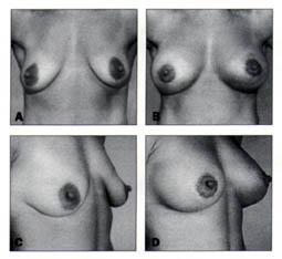A and C, Preoperative views of a 30 year old female patient with ptotic breast eith subglandular implant.