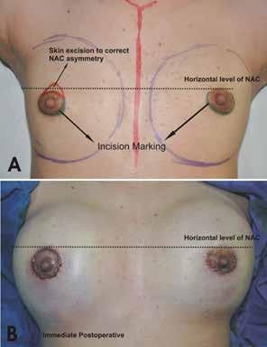 94 Periareolar extra-glandular breast augmentation is an important element of the overall strategic surgical plan.