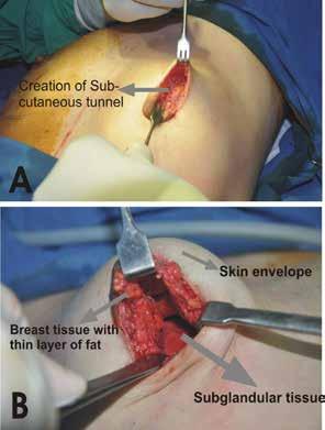 The closure was done in layers with absorbable 3-0 polyglactan sutures. An absorbable 4-0 suture was used for the subcutaneous skin closure, avoiding any stitch removal late on.