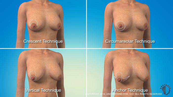 Breast Ptosis and Surgical Technique During a breast lift procedure, excess skin is removed, the breast tissue is reshaped, and the remaining skin is tightened.