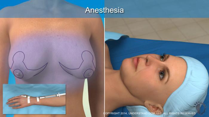 The anchor, or inverted T, technique involves an anchor-shaped incision that extends around the top of the areola and across the lower portion of the breast.
