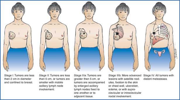 Malignant Breast Disorders: Cancer of Treatment depends on stage of tumor Figure 60-5 Breast cancer stages Slide 13 Malignant Breast Disorders: Cancer of Surgery Lumpectomy; partial mastectomy;