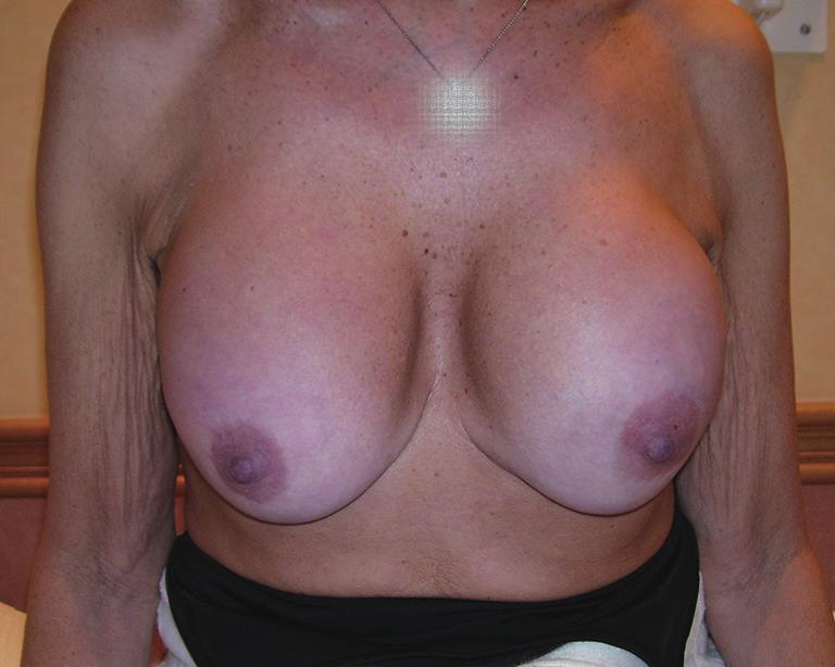 194 Frame. Waterfall after breast augmentation Figure 1 Breast augmentation with round McGhan implants within submammary pockets showing sliding ptosis of breast parenchyma 10 years later.