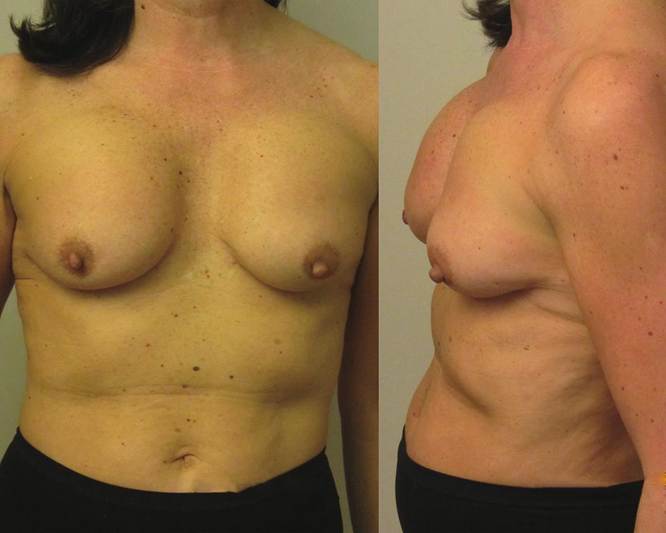 Figure 2 Subpectoral anatomical shaped McGhan implants have rotated and are now positioned too high on the chest wall causing a pseudoptosis effect of the overlying mobile breast tissue.