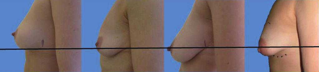 196 Frame. Waterfall after breast augmentation Figure 7 The levels of breast ptosis as defined by positioning of the nipple in relationship with the sub-mammary fold (SMF).