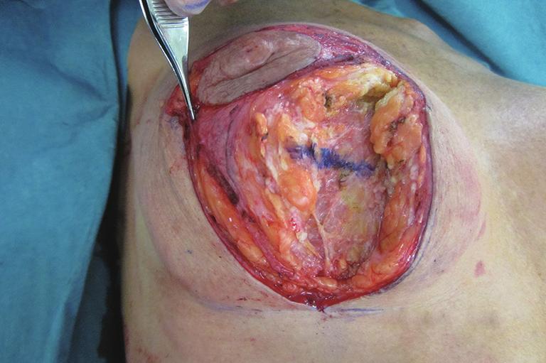 Gland Surgery, Vol 6, No 2 April 2017 199 Figure 12 Vertical scar right mastopexy over subfascial polyurethane breast implants.