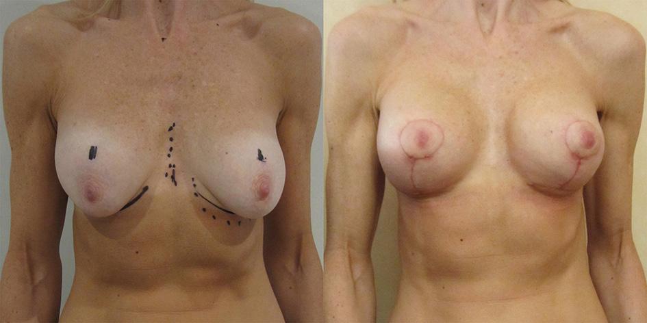 200 Frame. Waterfall after breast augmentation Figure 17 Vertical scar augmentation/mastopexy over conical polyurethane breast implants. Figure 18 Same patient oblique view.