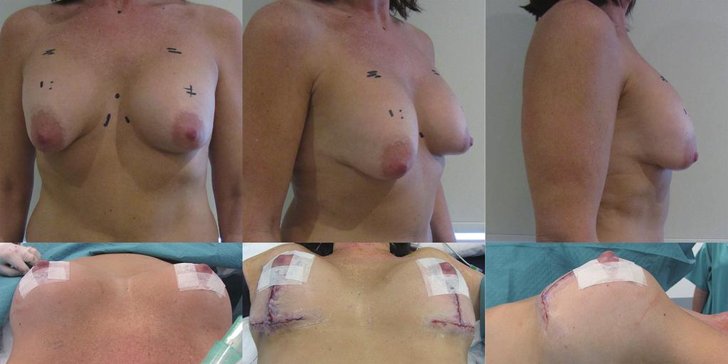 Gland Surgery, Vol 6, No 2 April 2017 201 Figure 19 Pre-operative erect posture views showing sliding ptosis of conical breasts over polyurethane implants. On-table short horizontal scar mastopexy.