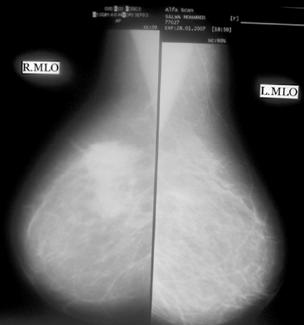 multiformat CR film combining the CC & MLO views of the right breast and the associated