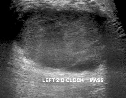 (1): A 51-year-old female with an inherently dense breast parenchyma showing an area of focal increased density within