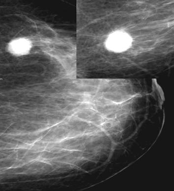(9): A 40-year-old female with a palpable left breast mass.
