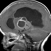 ASSOCIATED HYDROCEPHALUS MAY NEED TO