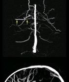 BEING CONSIDERED REQUIRE ANGIOGRAPHY (MR OR