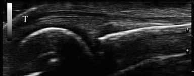 the ultrasonographic aspects of the non-traumatic lesions of the fingers.