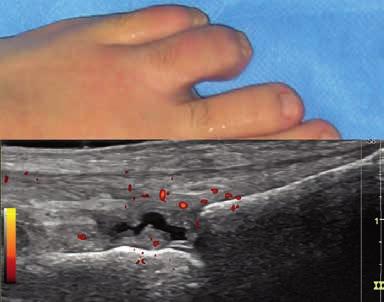 148 Daniela Fodor et al Ultrasonography of the non-traumatic lesions of the fingers Fig 4. Longitudinal scan of the normal nail.