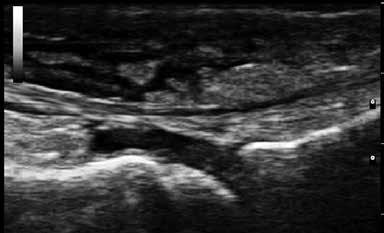 Longitudinal scan of the dorsal 2 nd metacarpophalangeal (MTF) joint in a 31 years old woman with seronegative spondilarthropatiy.
