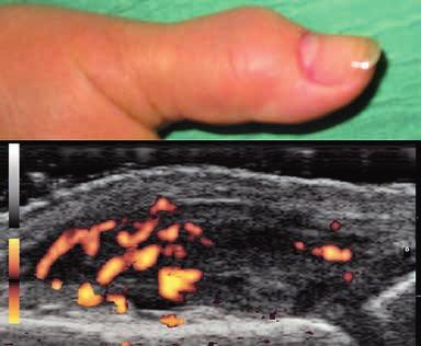 A 47 years old woman with psoriatic arthritis. Longitudinal dorsal scan. Fig 10. A 75 years old man with gout. Longitudinal dorsal scan of the 3 rd finger.