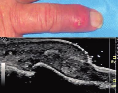 Clinical and US aspect of the thumb in a 56 years old woman with systemic erythematosus lupus.