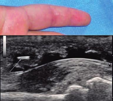 150 Daniela Fodor et al Ultrasonography of the non-traumatic lesions of the fingers Fig 13. The dactylitic aspect of the 2nd finger due to a wood splinter (arrow) near the flexor tendon.