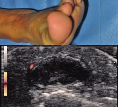 Med Ultrason 2013; 15(2): 147-153 151 Fig 17. Hypoechoic ganglia cyst with thick walls in the distal phalanx of the big toe. Fig 20. Postsurgery epidermal inclusion cyst.
