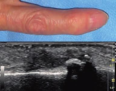 The tendon sheath cysts generally can be mobilized with the tendon during the dynamic examination (fig 18).These types of lesions are the main etiology for the trigger finger.