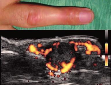 152 Daniela Fodor et al Ultrasonography of the non-traumatic lesions of the fingers Fig 22. Glomus tumor in the subungual region. Note the scalloping of the bone cortex (arrows). Fig 24.