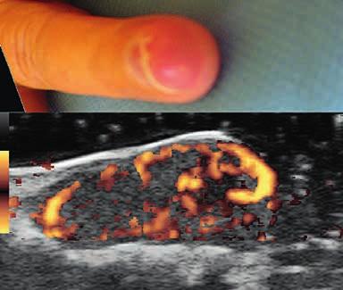 Note the partial destruction of the nail. Fig 25. Hard tophus over the MTF I joint. The important posterior shadow does not permit the US evaluation of the deeper structures.