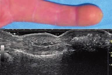 Conclusions US is an important tool for finger imaging examination being an established efficient, safe, cost-effective, and patient-friendly method to evaluate the structure of the normal and