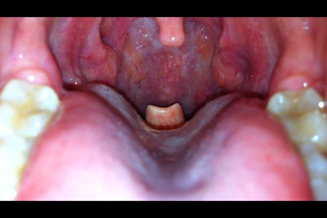 Epiglottis A flap of soft tissue covers the entrance
