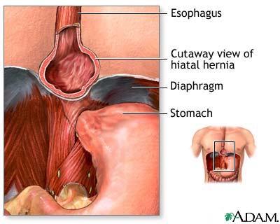 Hiatus Hernia Structural disorder A portion of the stomach pushes up