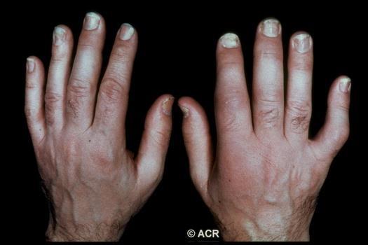 Psoriatic arthritis Know It When You See It Inflammation of the DIP joints Sausage fingers Joint