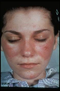 Systemic lupus erythematosus Butterfly rash Know It When You See It