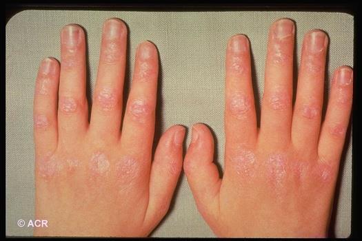Dermatomyositis Know It When You See It Scaly rash