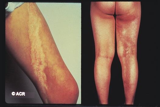 Linear scleroderma Not usually associated