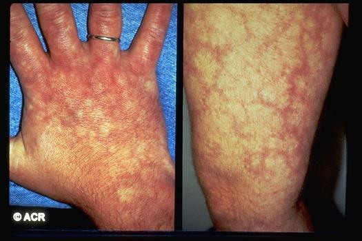 Livedo reticularis Know It When You See It Appears in a broadbased interrupted pattern in