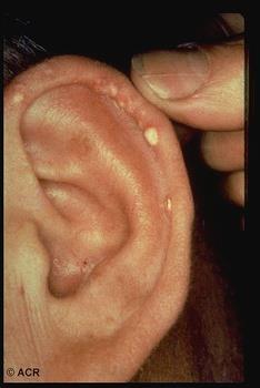 Know It When You See It Gout tophi in the ear a good tip-off if present Tophi appear rather late in gout Prick the