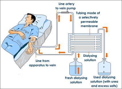 EXCRETORY SYSTEM If you loose your kidneys you need to have your blood filtered by dialysis.