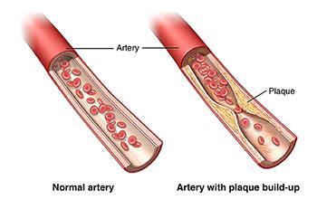 THE CIRCULATORY SYSTEM Cardiovascular Diseases Atherosclerosis occurs when fatty plaque