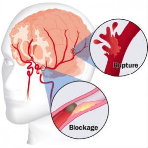 THE CIRCULATORY SYSTEM Stroke occurs when the blood flow to part of your brain stops.