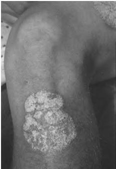 a patient with 20% body surface area affectedwith psoriasis lesions has around 8 billion blood circulating T cells compared with approximately 20 billion T cells located
