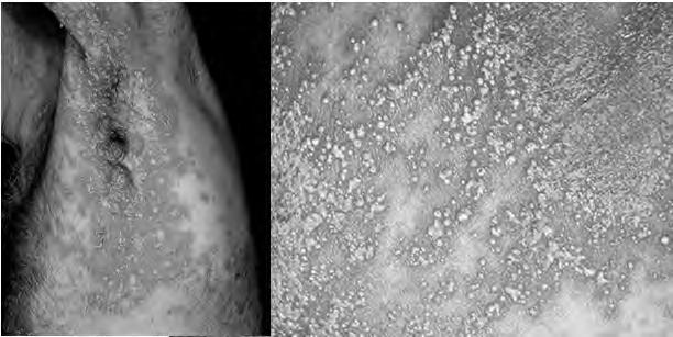 Guttate Psoriasis lesion size ~ drops of water common in children preceding strep pharyngitis ASO, anti-dnase B,