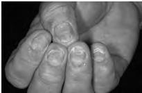 Nail Pathology pits = parakeratosis of proximal nail matrix oil spots = nail bed exocytosis of