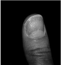 subungual hyperkeratosis = parakeratosis of distal nail bed onycholysis = parakeratosis of distal nail