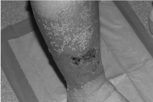 75 year old female with CHF admitted for lower extremity cellulitis, BMI 32 Stasis Dermatitis Common inflammatory skin disease that occurs on the lower extremities It is usually the earliest