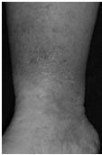 Complications of Stasis Dermatitis Cellulitis Nonhealing venous ulcers