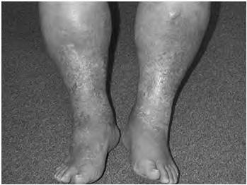 (autoeczematization) Lipodermatosclerosis Stasis Dermatitis - Treatment Compression