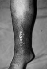 appearance Discomfort Topical steroids Atrophy is an issue Possible susceptibility to