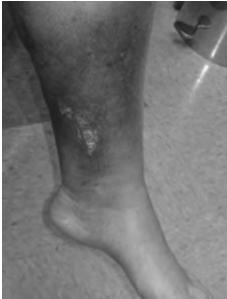 Follow up for Stasis Dermatitis Stasis dermatitis is a chronic condition Acute exacerbations should be closely monitored with weekly office visits Careful observation for signs of infection