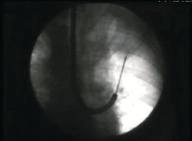 S. GASPARINI a) b) Fig. 4. a) Transbronchial needle aspiration and b) transbronchial biopsy of a solitary pulmonary nodule of the left upper lobe.
